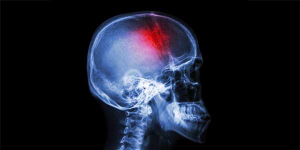 Atención de traumatismo craneoencefálico por el Dr. Jorge M. Flores